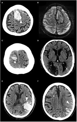 CT-Visible Convexity Subarachnoid Hemorrhage Predicts Early Recurrence of Lobar Hemorrhage